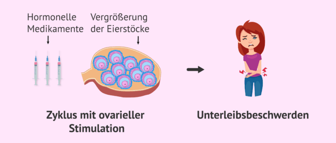 Imagen: Beschwerden durch die ovarielle Stimulation