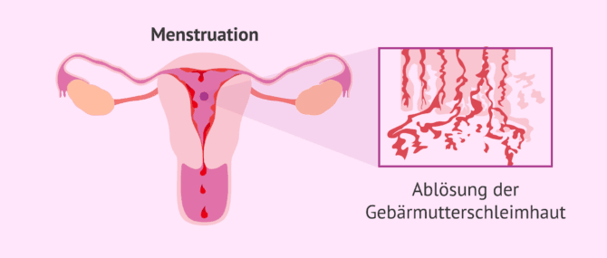 Imagen: Menstruation: Ablösung des Endometriums