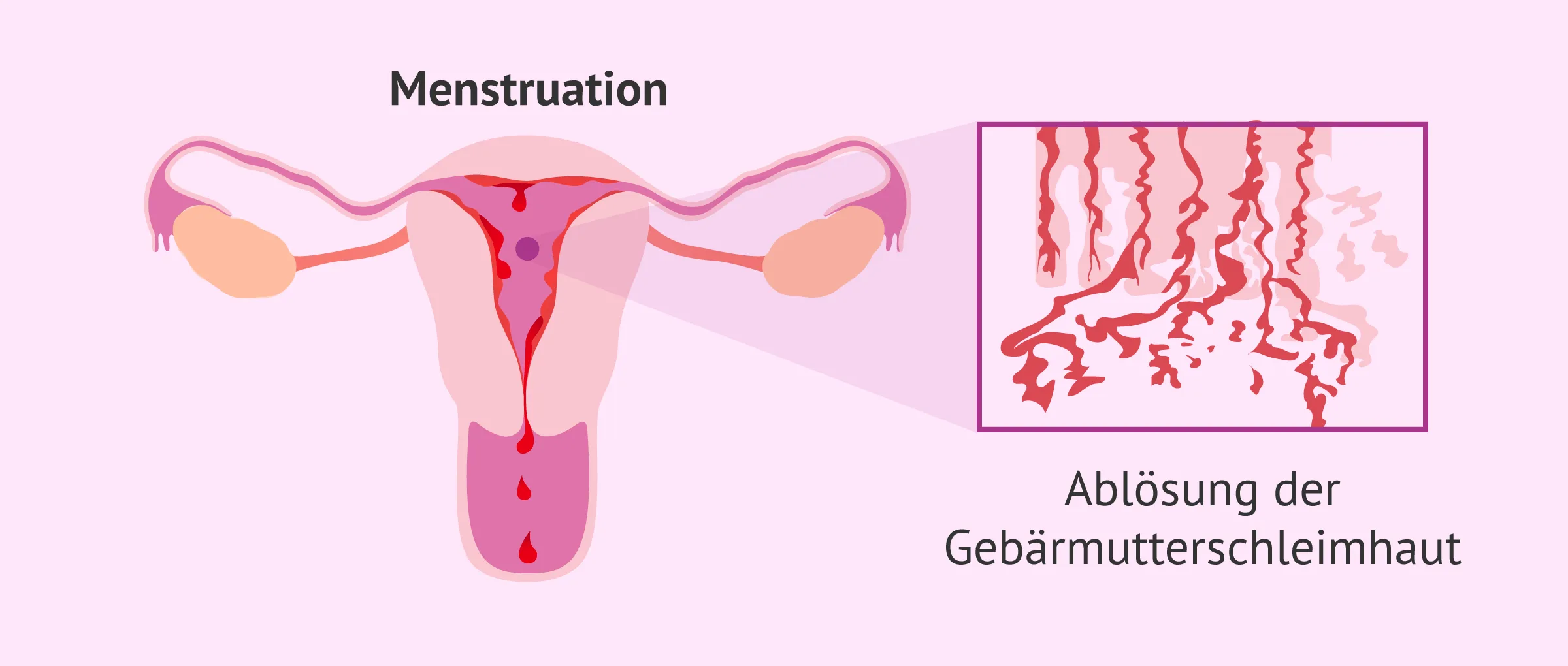 Menstruation: Ablösung des Endometriums