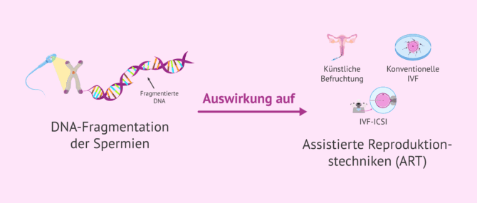 Imagen: Wie wirkt sich die DNA-Fragmentation der Spermien auf die assistierte Reproduktion aus?