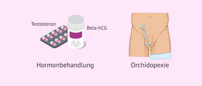 Imagen: Mögliche Behandlungen für Kryptorchismus