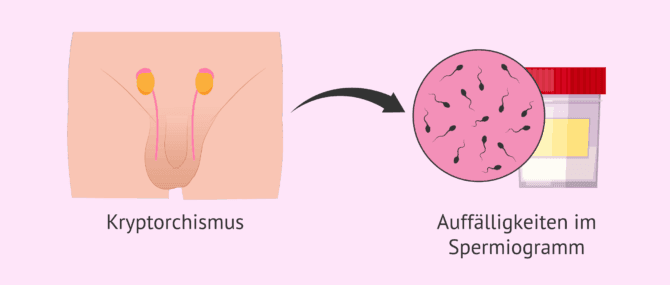 Imagen: Beeinflusst Kryptorchismus die männliche Fruchtbarkeit?