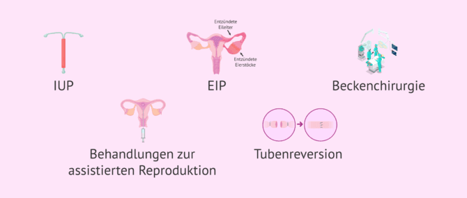 Imagen: Weitere Risikofaktoren einer extrauterinen Schwangerschaft