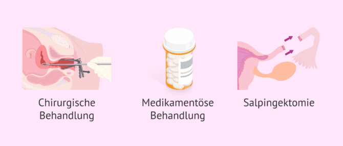 Imagen: Möglichkeiten zur Behandlung einer Eileiterschwangerschaft