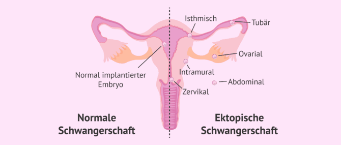 Imagen: Normale Schwangerschaft vs. Eileiterschwangerschaft