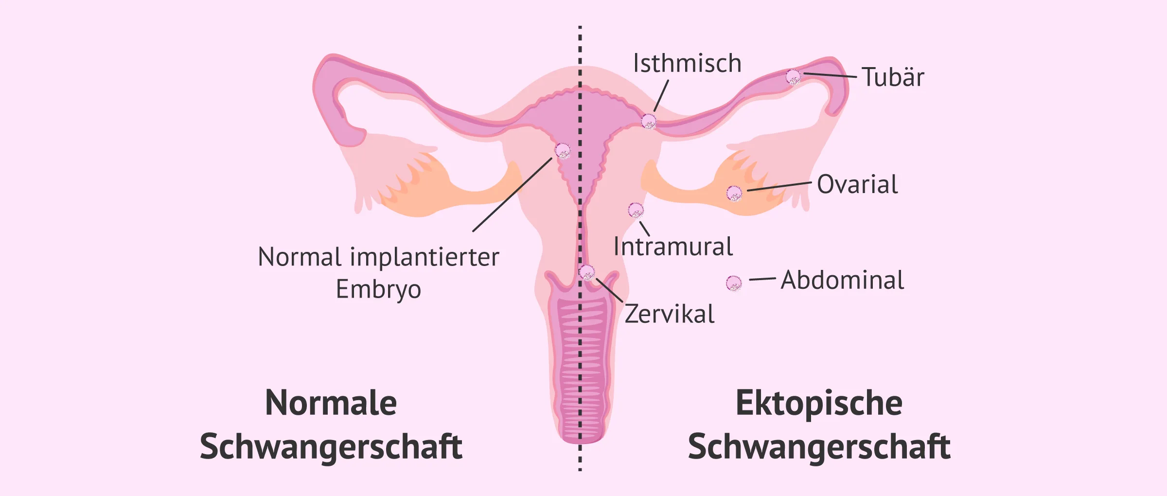 Was ist eine Eileiterschwangerschaft? Symptome und Diagnose