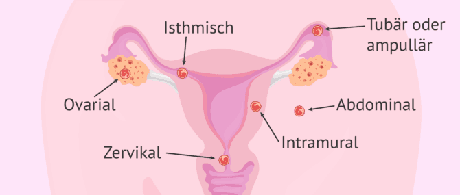 Imagen: Mögliche Lokalisationen des Embryos bei einer Eileiterschwangerschaft