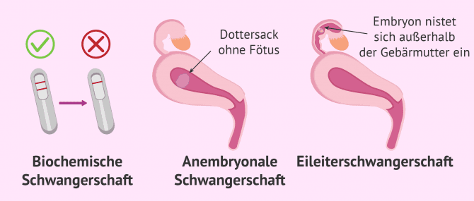 Imagen: Arten von Schwangerschaftsabbrüchen im ersten Trimester