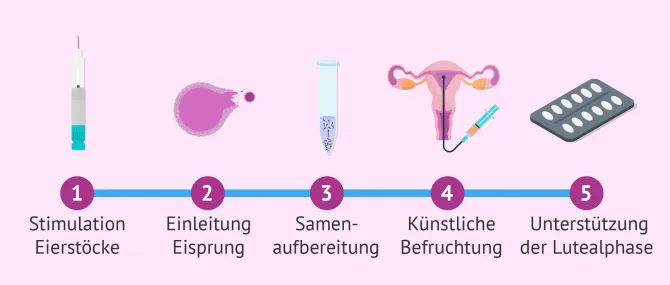 Knstliche Befruchtung: Methoden, Ablauf, Kosten und Risiken