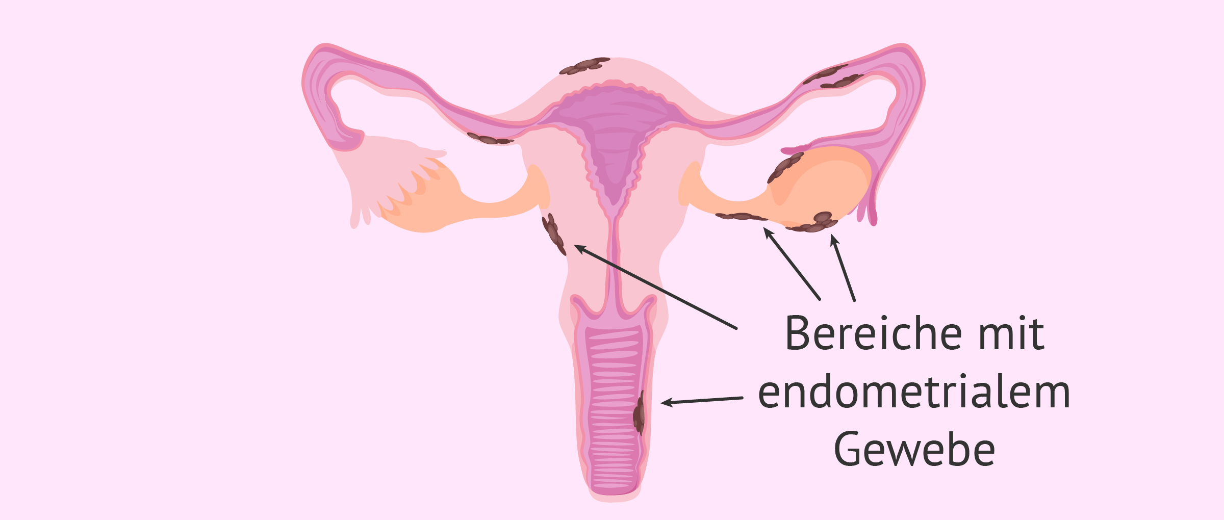 Lokalisierung der Endometriose