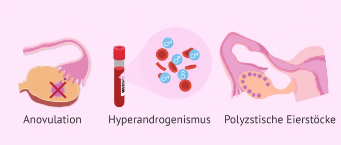 Imagen: Diagnose der PCSO mithilfe der Rotterdammer Kriterien