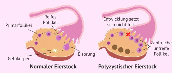 Imagen: Normale vs. polyzystische Ovarien
