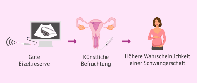 Imagen: Eizellreserve und Schwangerschaft durch künstliche Befruchtung