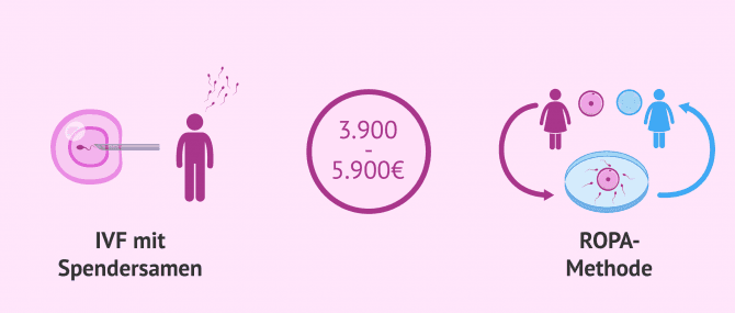 Imagen: Kosten der IVF-Behandlung mit Samenspende