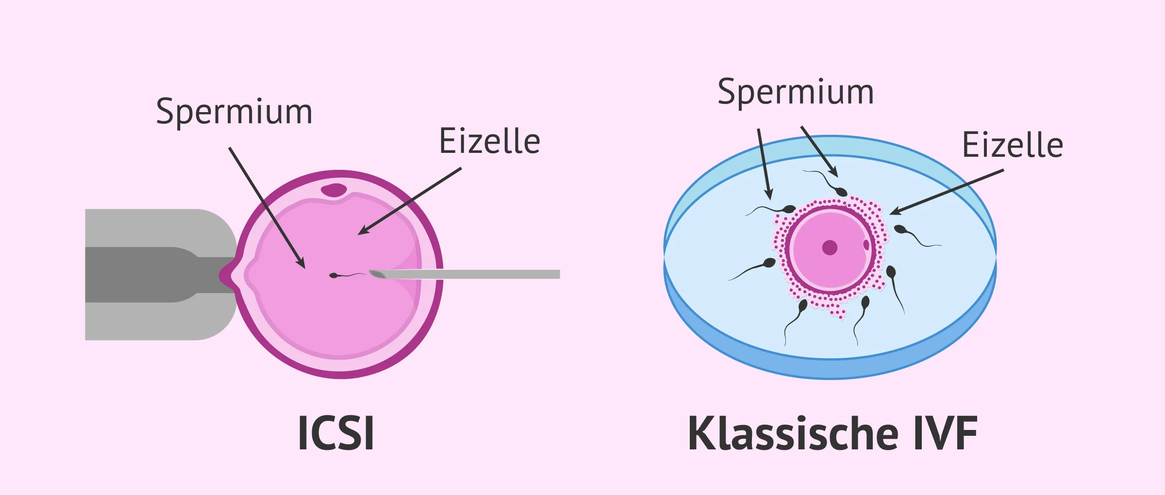 Intrazytoplasmatische Spermieninjektion (ICSI)