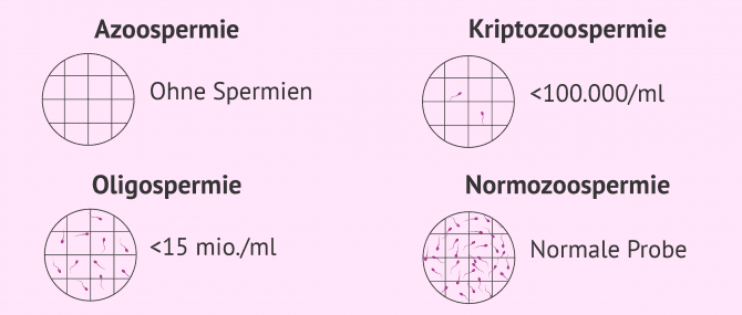 Imagen: Spermienkonzentration im Spermiogramm