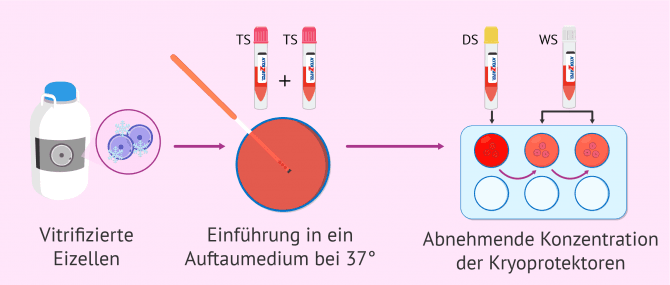 Imagen: Vorgang in einer Devitrifizierung