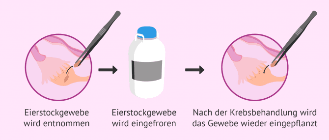 Imagen: Einfrieren von Eierstockgewebe
