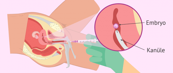 Imagen: Embryotransfer