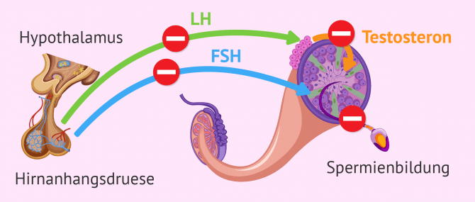 Imagen: Endokrinologischer Faktor bei männlicher Unfruchtbarkeit