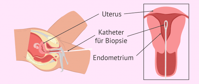 Imagen: Durchführung einer Endometriumbiopsie