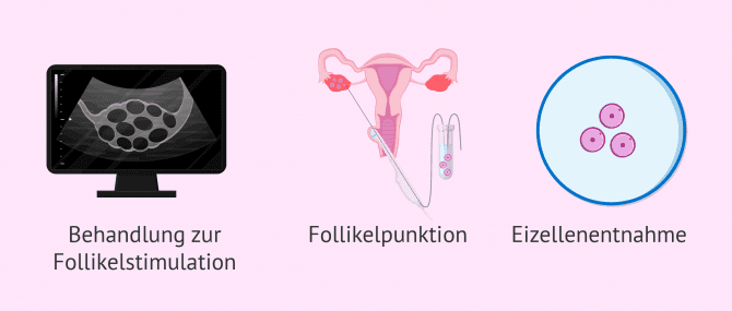 Imagen: Entname der Eizellen in der Vitrifizierung