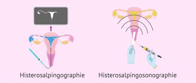 Imagen: Hysterosalpingografie