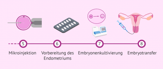 Imagen: Letzte Etappen im ICSI-Prozess