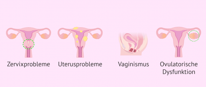 Imagen: Indikationen IUI Sterilität bei Frauen