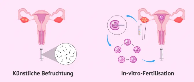 Methoden und Kosten der Behandlungen in der assistieren Reproduktion
