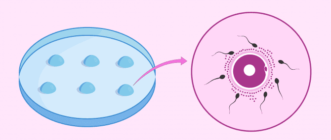 Imagen: konventionelle IVF