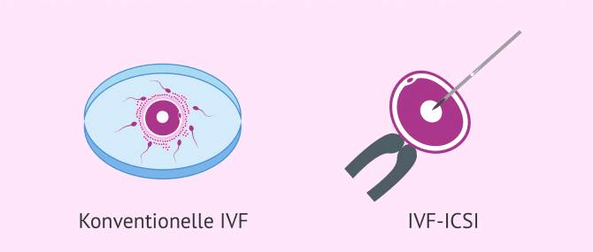 Imagen: konventionelle IVF oder ICSI