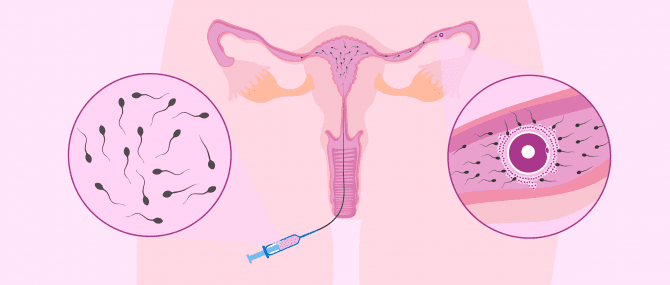 Imagen: Die intrauterine Insemination