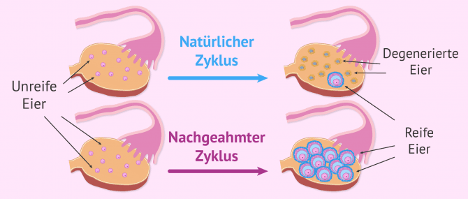 Imagen: Zweck einer Follikelstimulation