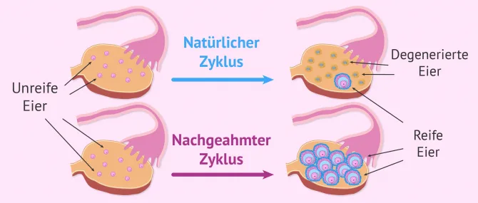 Imagen: Zweck einer Follikelstimulation