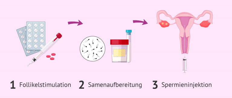 Wie Läuft Künstliche Befruchtung Ab