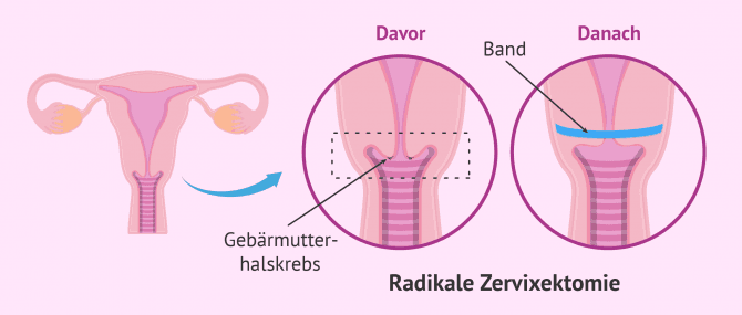 Imagen: Radikale Zervixektomie