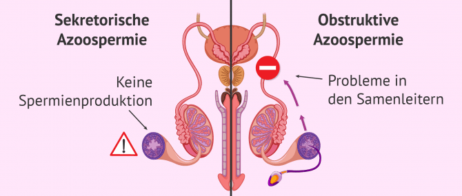 Imagen: Unterschiede zwischen obstruktiver und sekretorischer Azoospermie