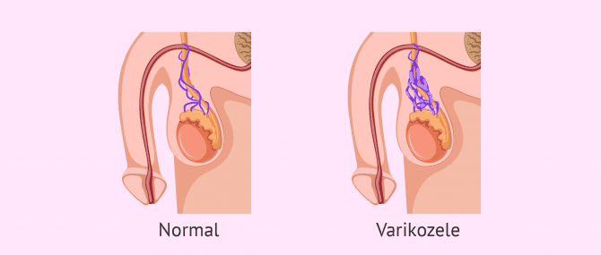 Imagen: Erweiterte Gefäße bei Varikozele