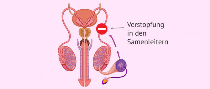 Imagen: Verstopfung der Samenleiter in der männlichen Unfruchtbarkeit