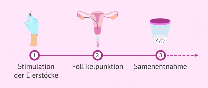 Imagen: Erste Schritte in einem IVF-Zyklus