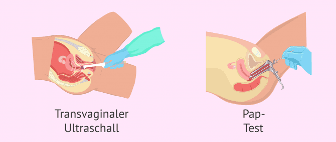 Imagen: Gynäkologische Untersuchungen um die Fruchtbarkeit zu überprüfen