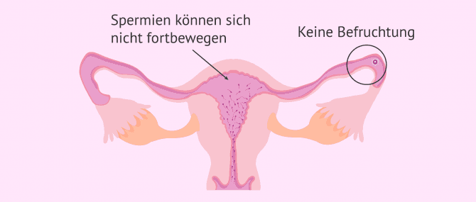Imagen: Astenozoospermie