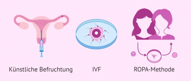 Kinderwunsch bei lesbischen Paaren mit IVF oder IUI