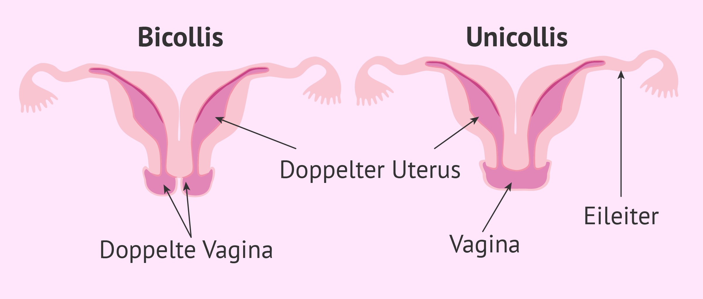 Uterus didelphys