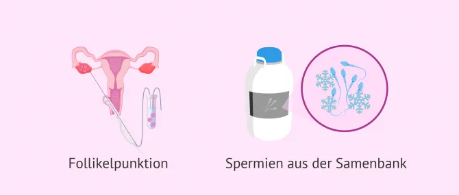Die IVF mit Samenspende: Verlauf und Erfolgsquoten