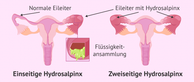 Imagen: Hydrosalpinx kann in einem oder beiden Eileitern auftauchen