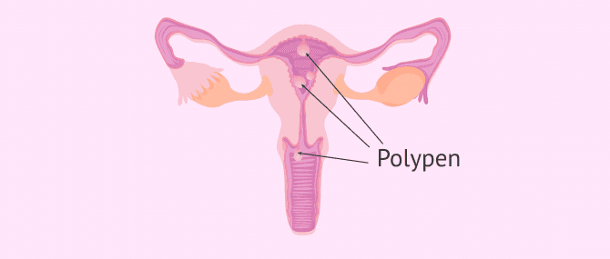 Imagen: Gebärmutterpolypen