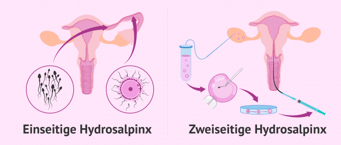 Imagen: Schwangerschaft mit Hydrosalpinx