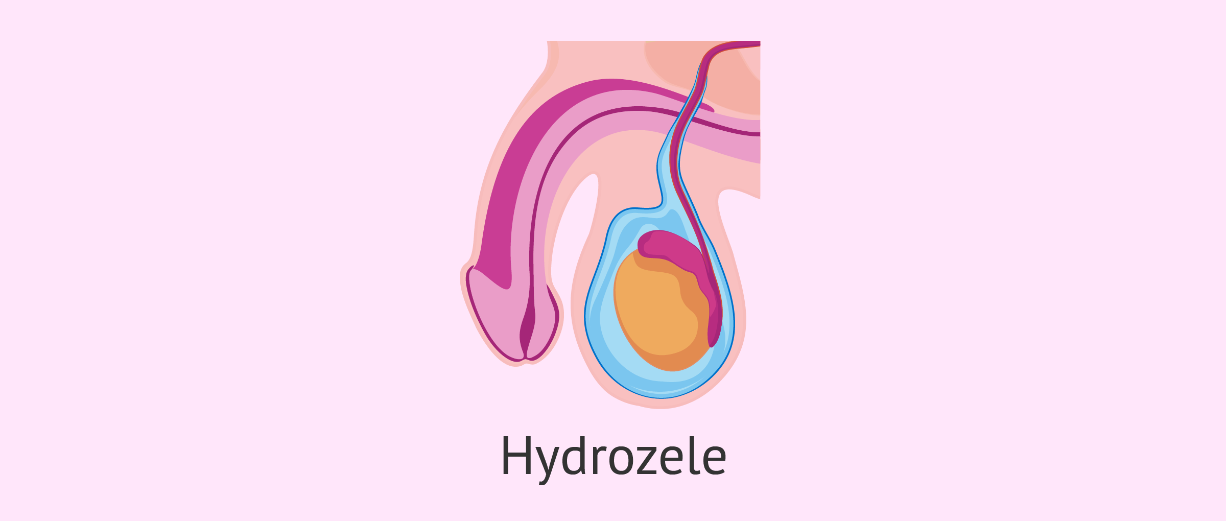 Hydrozele (Wasserbruch)